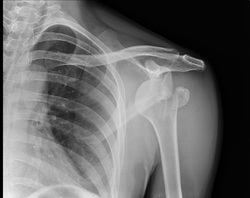 shoulder fracture dislocation