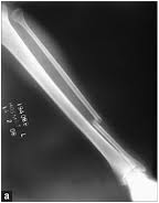 isolated fibula fracture