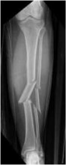 tibia fracture