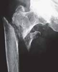 extracapsular hip fracture