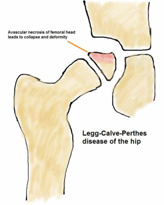 Perthes disease hip