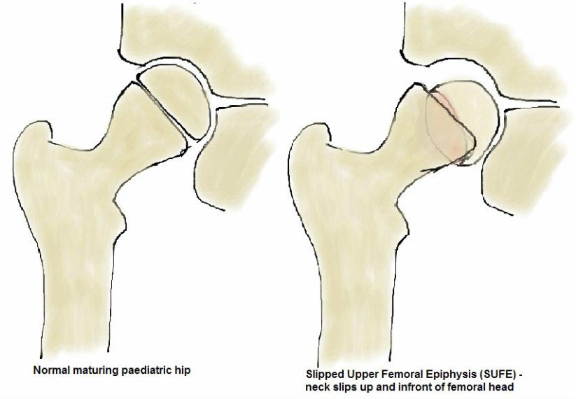 slipped upper/capital femoral epiphysis