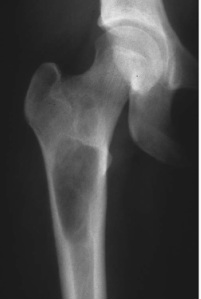 unicameral bone cyst