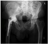 Infected total hip replacement