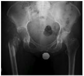 hip replacement, excision, girdlestone