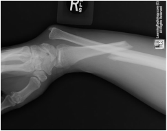Galeazzi forearm fracture dislocation
