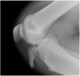tibial tuberosity fracture