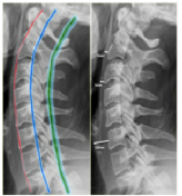 c-spine lines