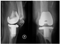 Knee peri-prosthetic fracture