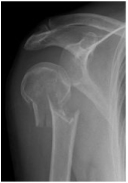 shoulder fracture