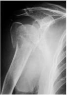 shoulder fracture
