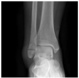 Weber A ankle fracture