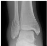 Weber B ankle fracture