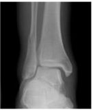 Weber C ankle fracture