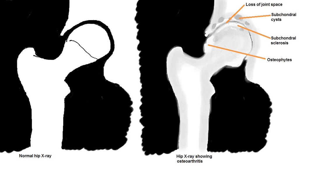 x-ray signs of osteoarthritis
