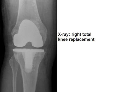 total knee replacement x-ray