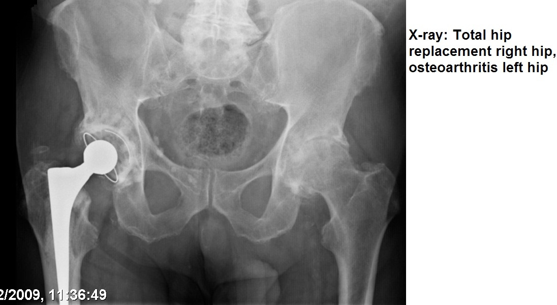 total hip replacement x-ray
