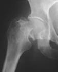 intracapsular hip fracture