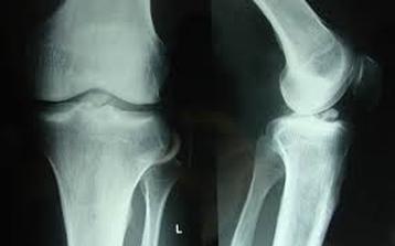 ACL avulsion fracture