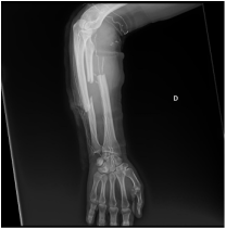 radius ulna, forearm fracture