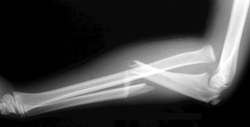 Monteggia forearm fracture dislocation
