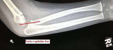 paediatric elbow fracture lines