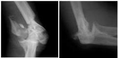 distal humerus, elbow fracture